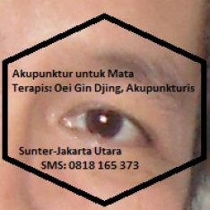Akupunktur Tanam Benang untuk Mata oleh Oei Gin Djing, Akupunkturis (Sunter-Jakarta), SMS: 0818 165 373